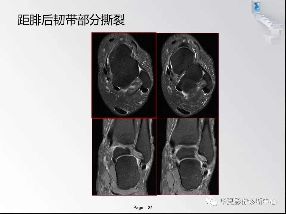 【PPT】踝关节韧带损伤MR表现与损伤机制分析-29