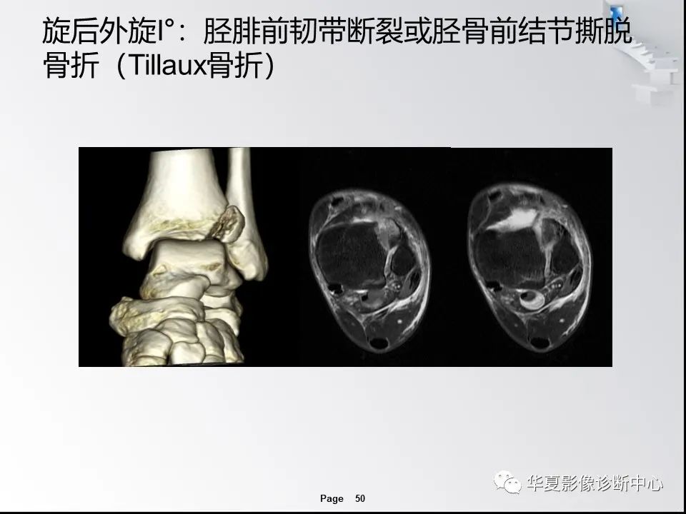 【PPT】踝关节韧带损伤MR表现与损伤机制分析-52