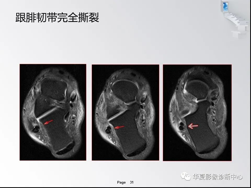 【PPT】踝关节韧带损伤MR表现与损伤机制分析-33