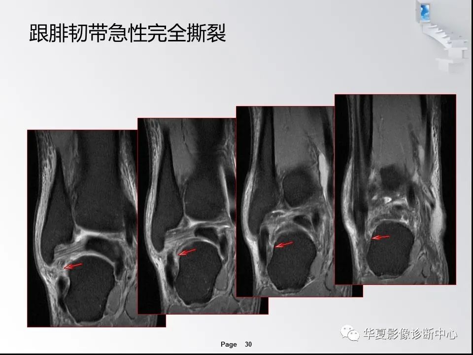 【PPT】踝关节韧带损伤MR表现与损伤机制分析-32