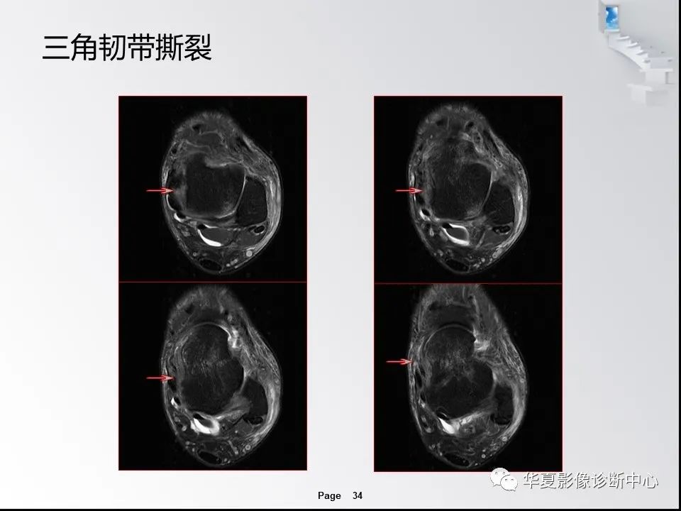 【PPT】踝关节韧带损伤MR表现与损伤机制分析-36