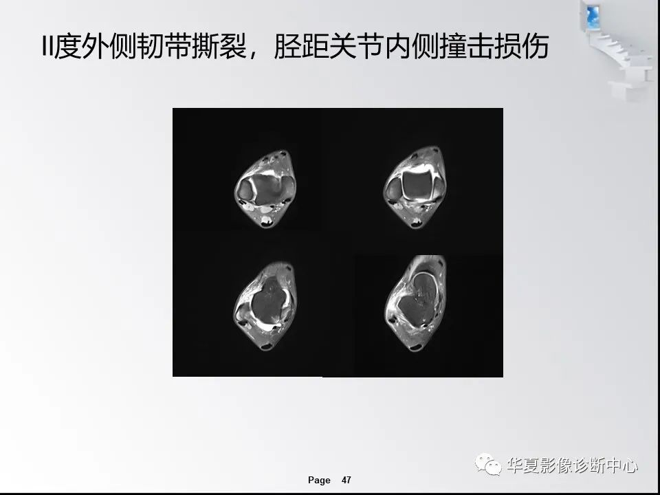 【PPT】踝关节韧带损伤MR表现与损伤机制分析-49