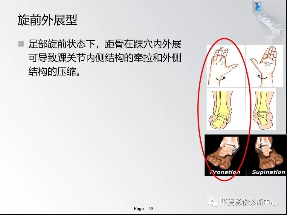 【PPT】踝关节韧带损伤MR表现与损伤机制分析-42