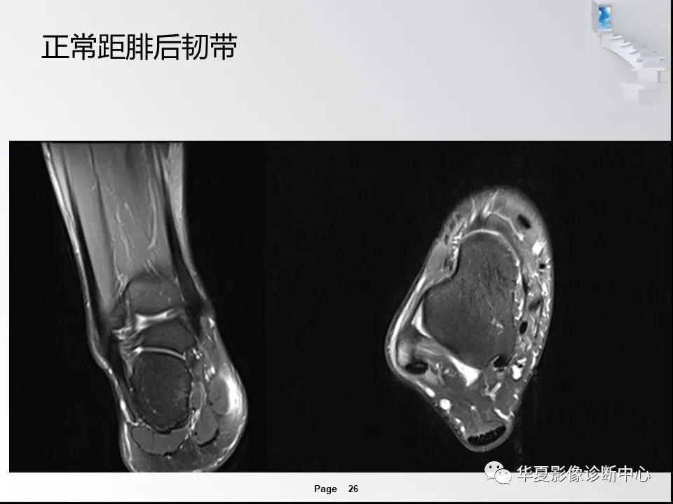 【PPT】踝关节韧带损伤MR表现与损伤机制分析-28