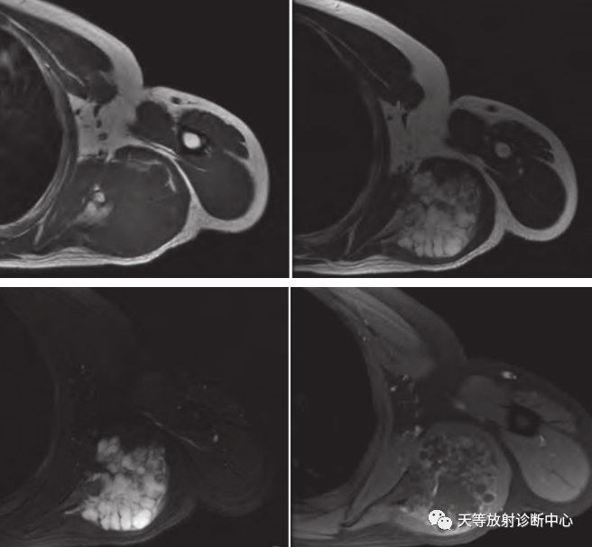 【病例】颈椎脊柱软骨肉瘤1例CT及MR影像-23