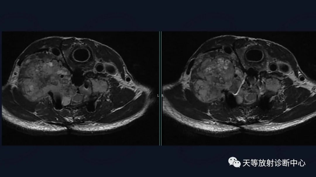 【病例】颈椎脊柱软骨肉瘤1例CT及MR影像-13
