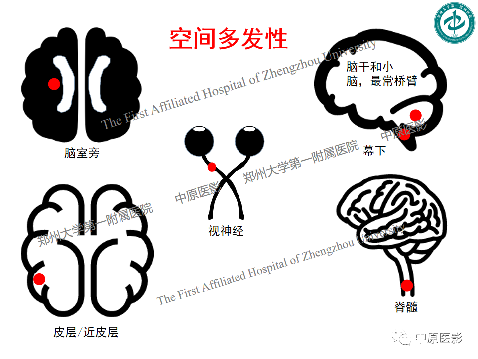 【PPT】视神经脊髓炎与多发性硬化鉴别诊断-21
