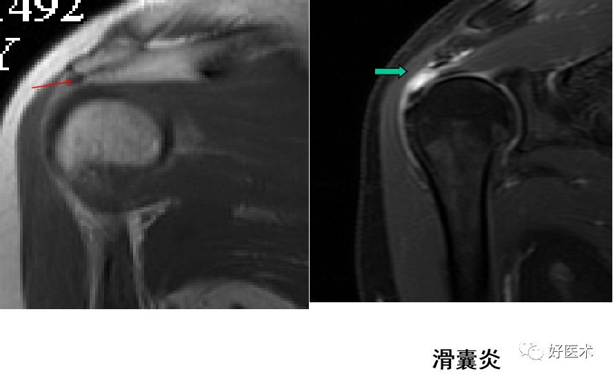 肩关节损伤的影像学诊断-30 肩关节损伤的影像学诊断-30