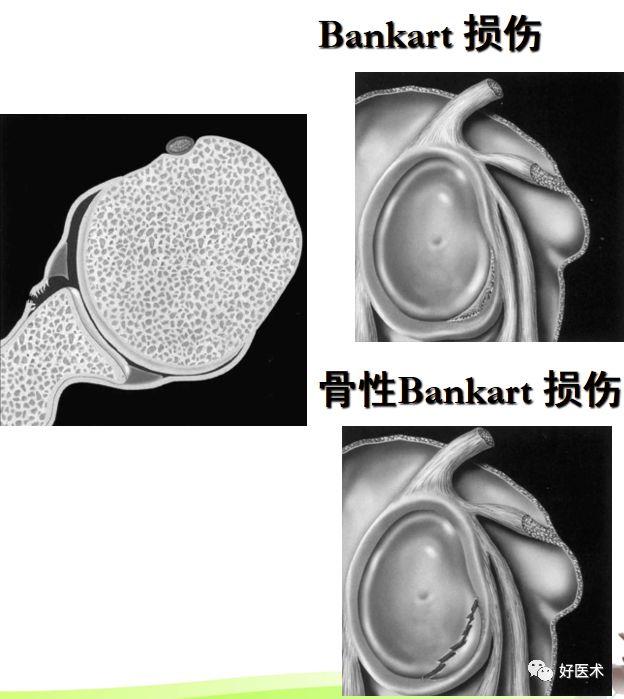 肩关节损伤的影像学诊断-47 肩关节损伤的影像学诊断-47