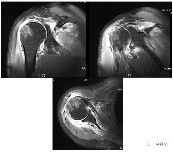 肩关节损伤的影像学诊断-39 肩关节损伤的影像学诊断-39