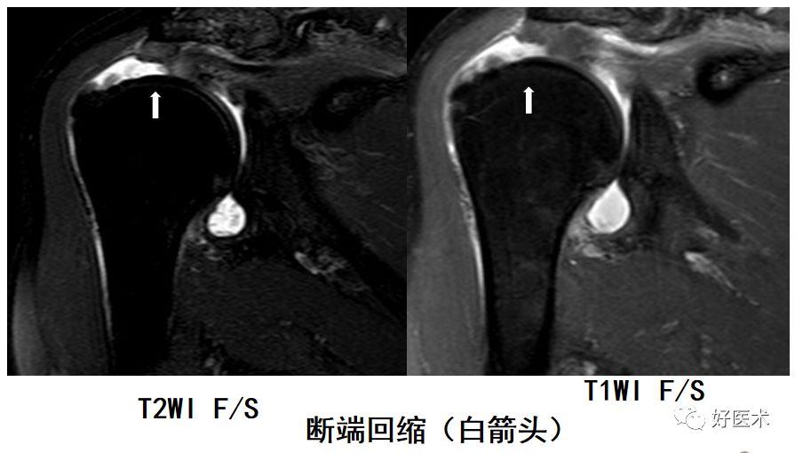 肩关节损伤的影像学诊断-37 肩关节损伤的影像学诊断-37
