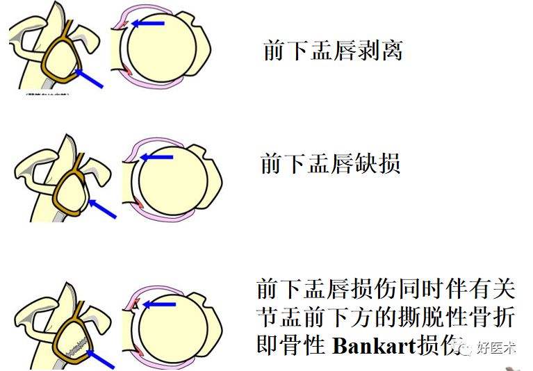 肩关节损伤的影像学诊断-46 肩关节损伤的影像学诊断-46