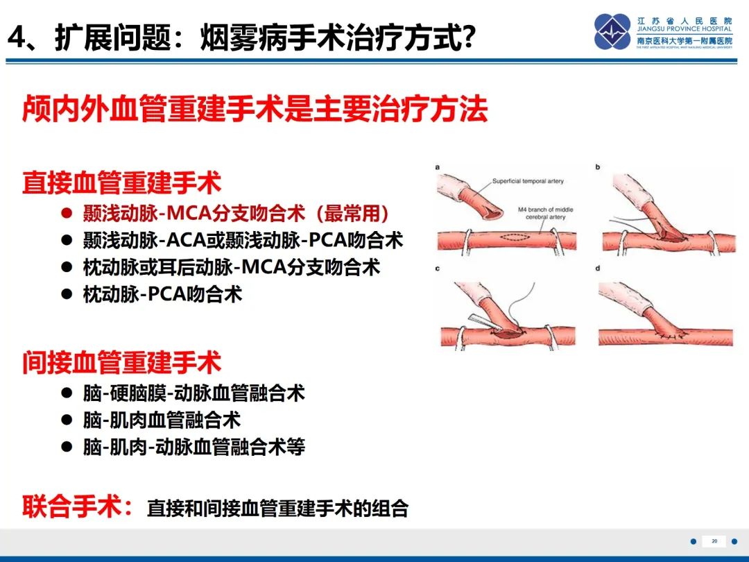 【PPT】烟雾病和烟雾综合征血管重建术后影像评估-21