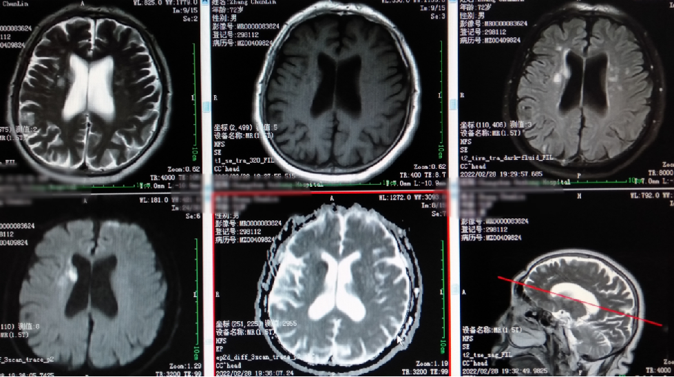 DWI、PWI在缺血性脑卒中上的应用以及联合应用对临床治疗方式选择的指导意义-7