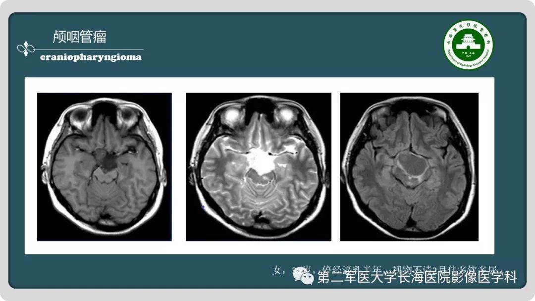 【PPT】颅内囊性病变影像表现-74