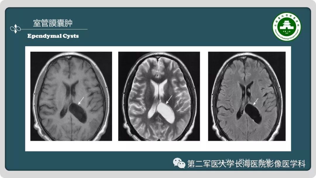 【PPT】颅内囊性病变影像表现-50