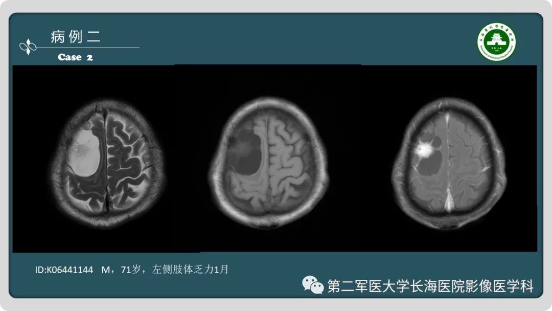 【PPT】颅内囊性病变影像表现-4