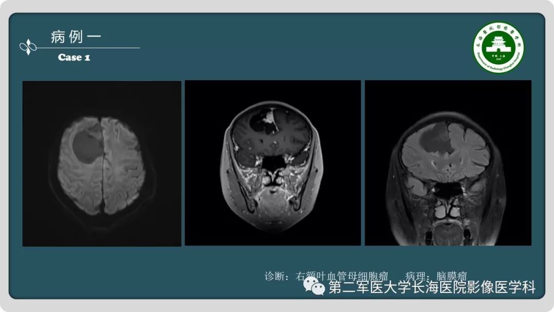 【PPT】颅内囊性病变影像表现-3