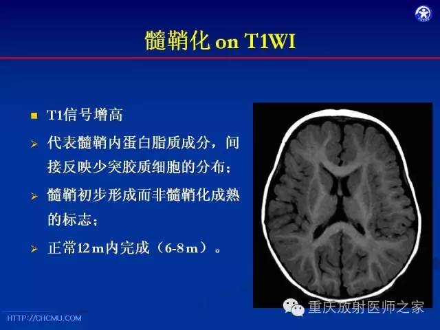 【PPT】脑白质髓鞘化及相关疾病的MRI表现-6