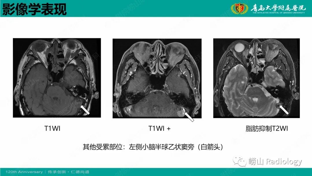 【病例】Rosai-Dorfman病 & 套细胞淋巴瘤-36