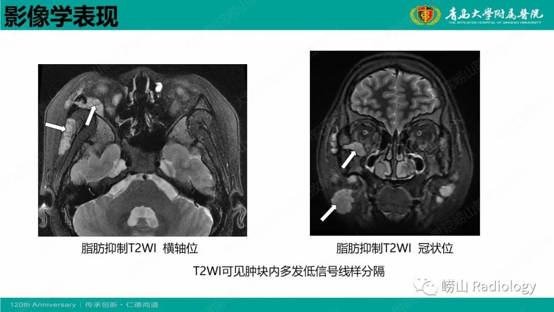 【病例】Rosai-Dorfman病 & 套细胞淋巴瘤-23