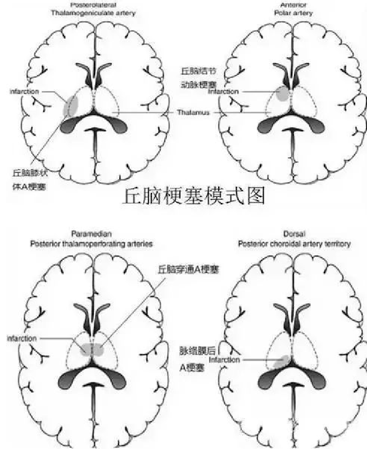 【病例】双侧丘脑梗死—Percheron动脉梗死1例MR影像-3