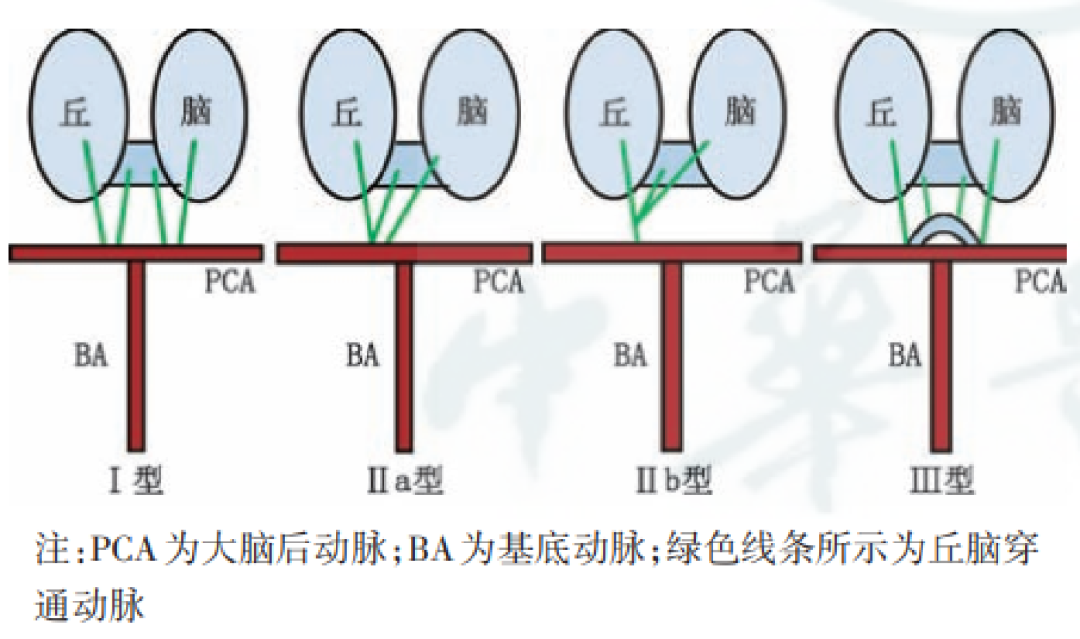【病例】双侧丘脑梗死—Percheron动脉梗死1例MR影像-4