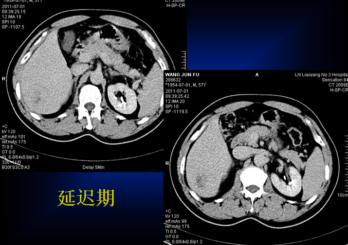 原发性肝癌的CT诊断