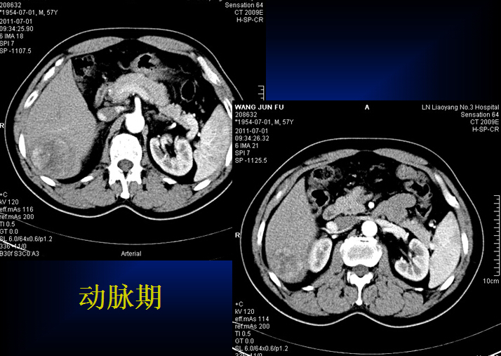 原发性肝癌的CT诊断