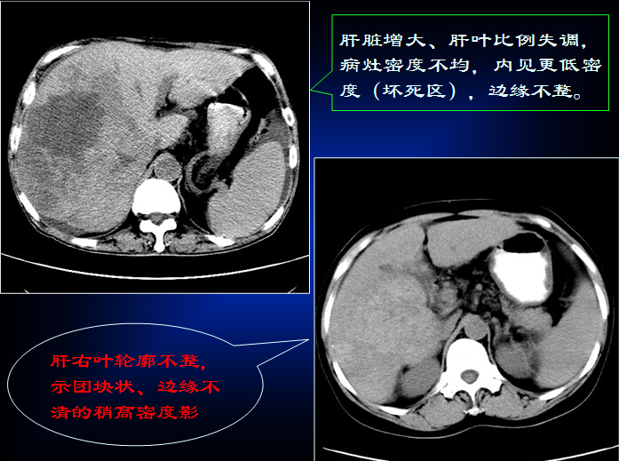 原发性肝癌的CT诊断