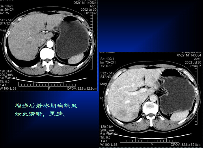 原发性肝癌的CT诊断
