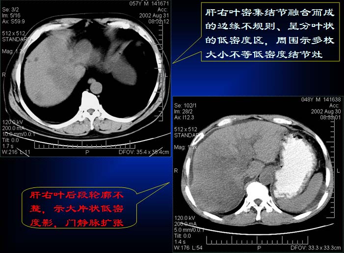 原发性肝癌的CT诊断