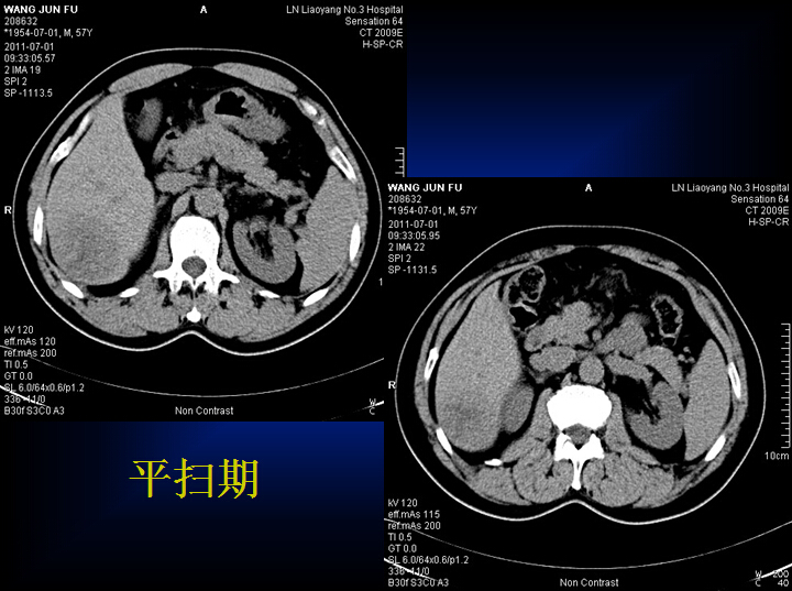 原发性肝癌的CT诊断