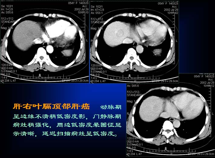 原发性肝癌的CT诊断