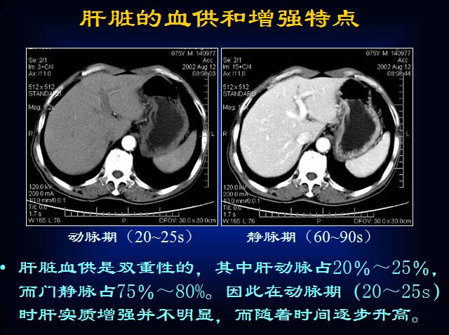 原发性肝癌的CT诊断