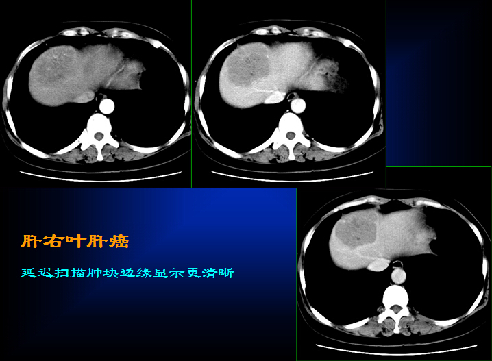 原发性肝癌的CT诊断