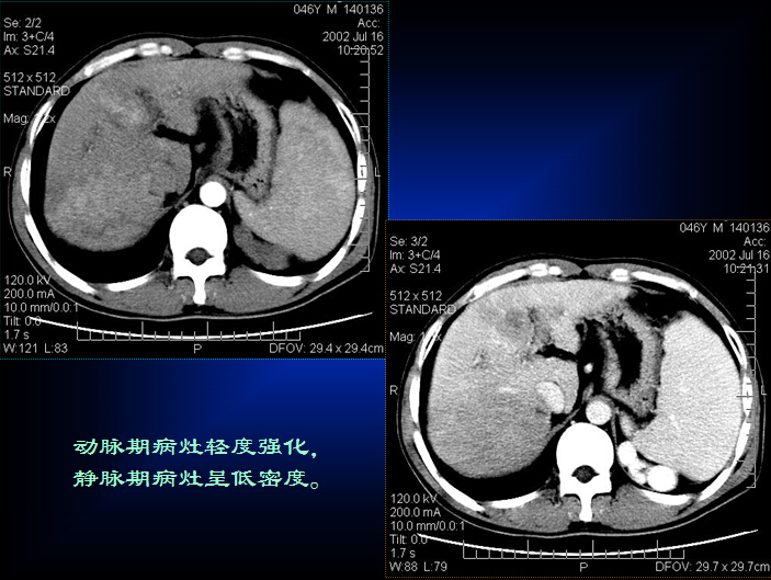 原发性肝癌的CT诊断