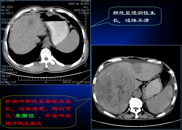 原发性肝癌的CT诊断