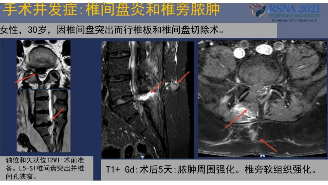【PPT】术后脊柱-为了外科医生和患者安全着想的金属图像-41
