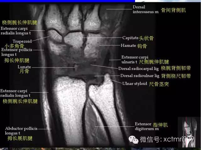 【PPT】腕关节MRI解剖中英对照-11