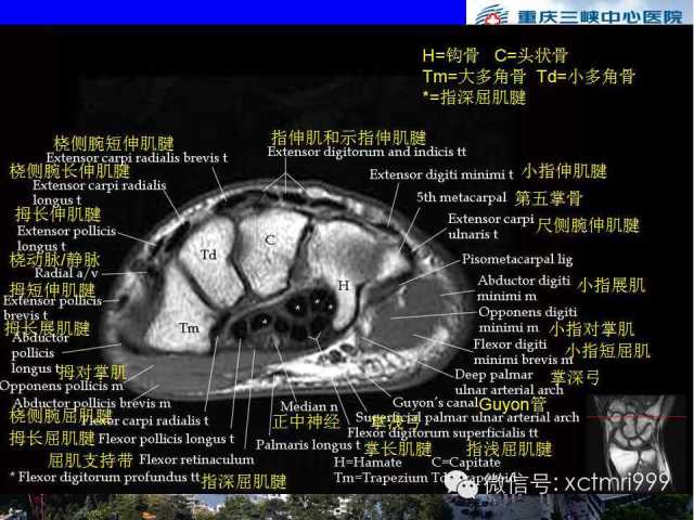 【PPT】腕关节MRI解剖中英对照-45