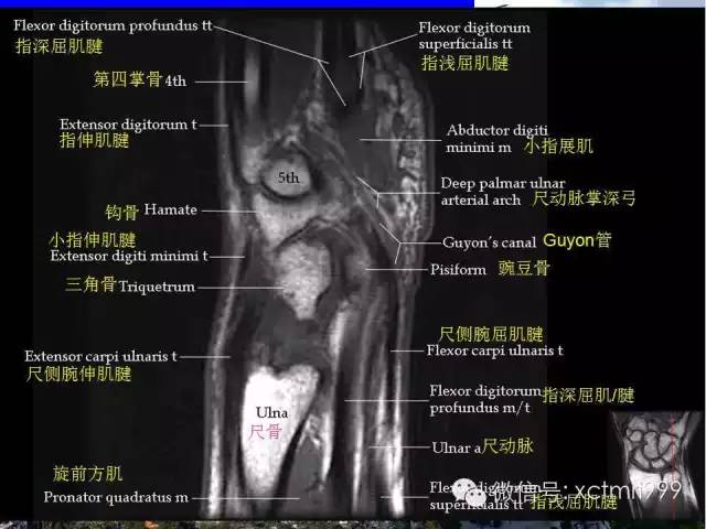【PPT】腕关节MRI解剖中英对照-18