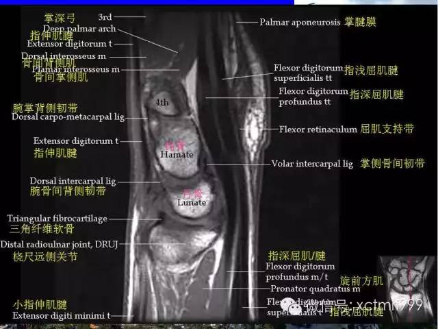 【PPT】腕关节MRI解剖中英对照-21