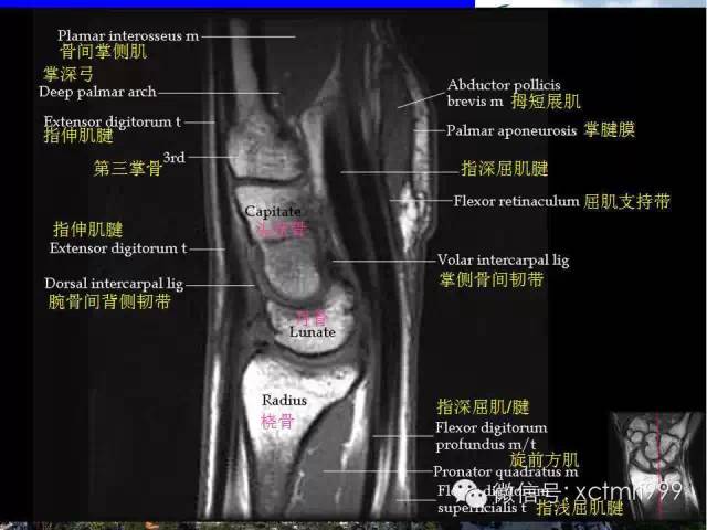 【PPT】腕关节MRI解剖中英对照-22