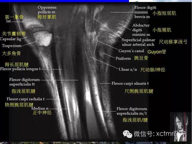 【PPT】腕关节MRI解剖中英对照-5