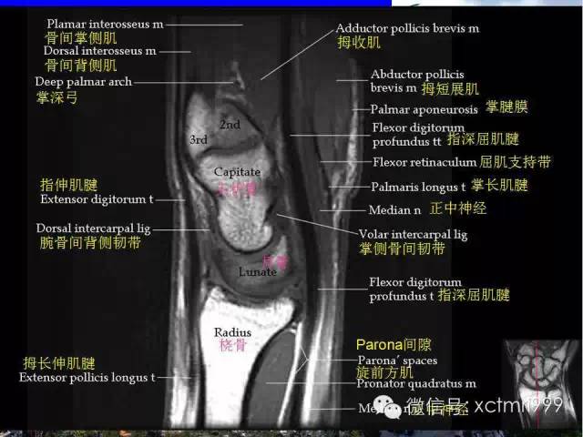 【PPT】腕关节MRI解剖中英对照-24