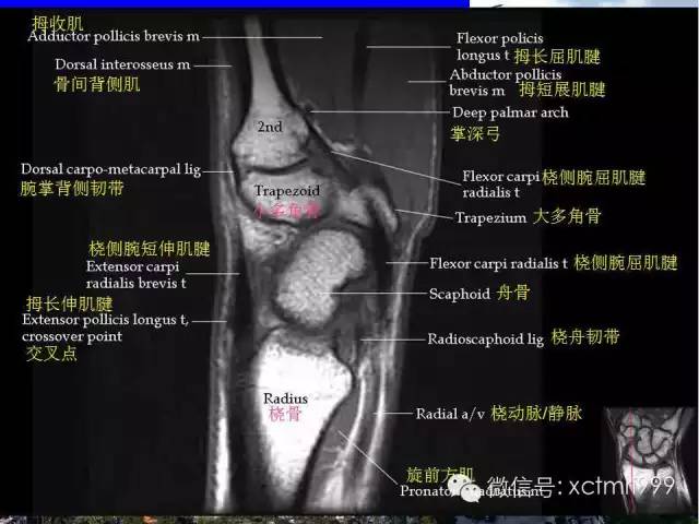【PPT】腕关节MRI解剖中英对照-26