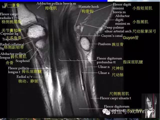 【PPT】腕关节MRI解剖中英对照-6