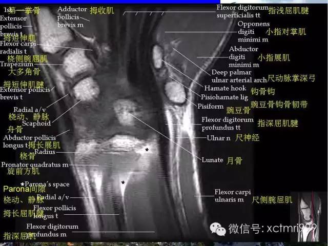 【PPT】腕关节MRI解剖中英对照-7
