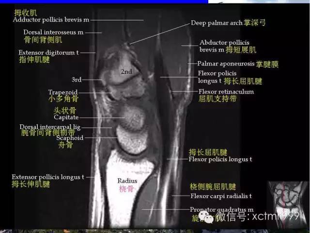 【PPT】腕关节MRI解剖中英对照-25